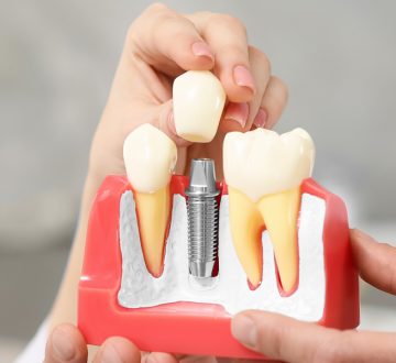 Understanding Dental Implants: Your First Step to a New Smile