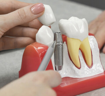 Dental Implants Benefit for Oral Health and Overall Well-being