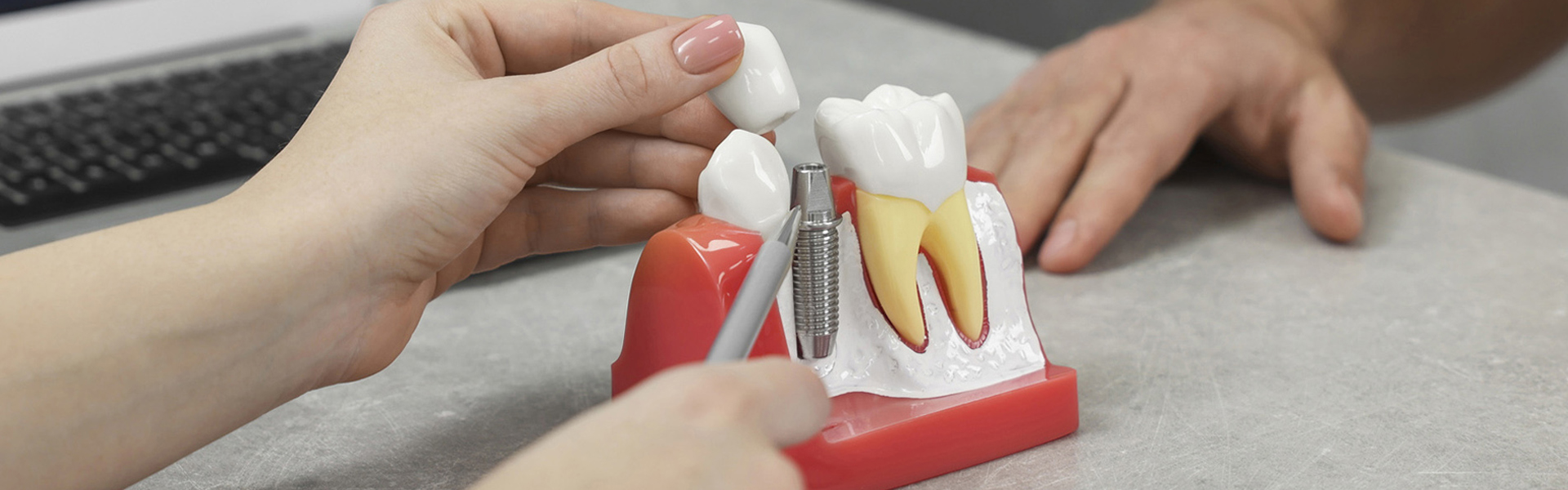Dental Implants Benefit for Oral Health and Overall Well-being Dental Implants Benefit for Oral Health and Overall Well-being