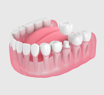 How Long Do Dental Crowns Last? A Dentist’s Guide