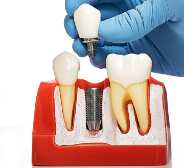 Benefits of Choosing Dental Implants Than Any Other Tooth Replacement Option